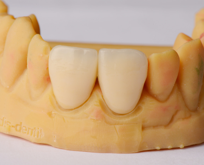 Facettes DentikLab Facettes DentikLab